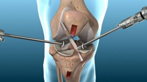 Arthroscopy